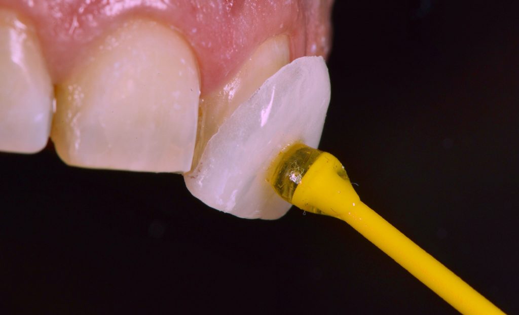 laminados dentales