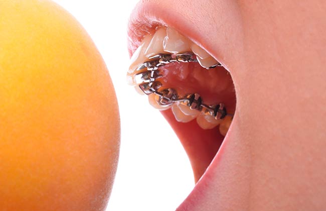 tratamiento ortodoncia