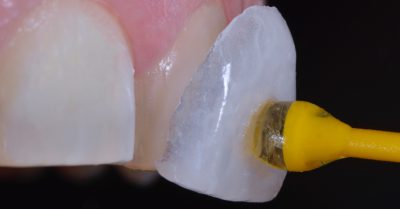 carillas dentales composite